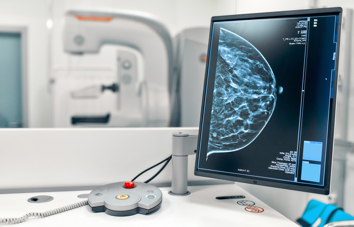 Câncer de mama: mulheres adiam diagnóstico e números de mastectomia crescem